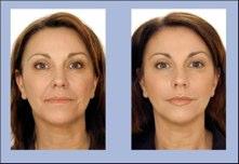 Botox and Dermal fillers (Liquid face lift)